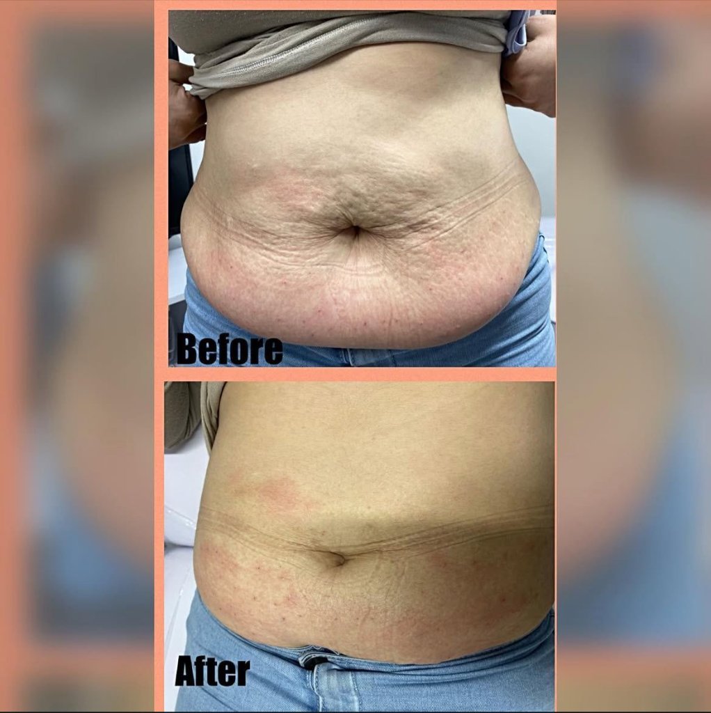 Body Contouring