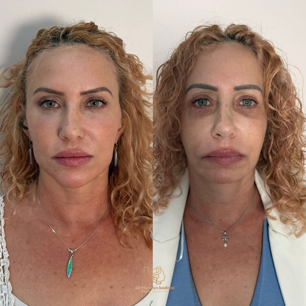 Face Rejuvenation