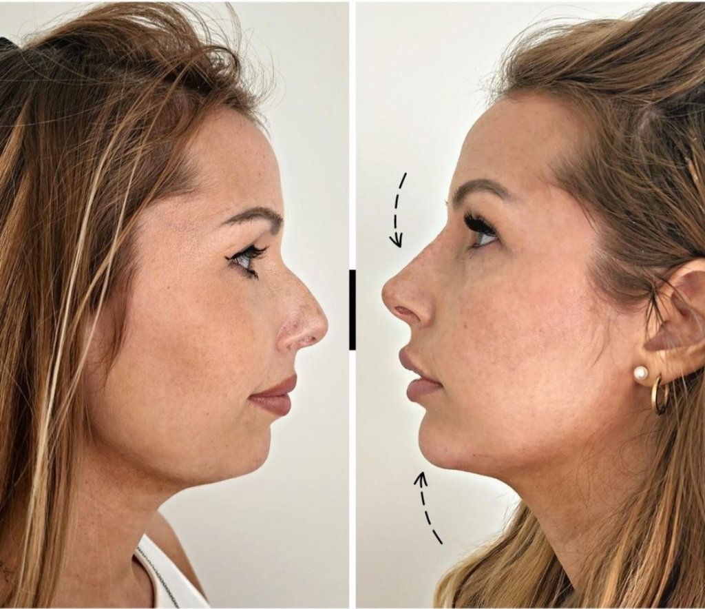 Non-Surgical Nose Sculpting